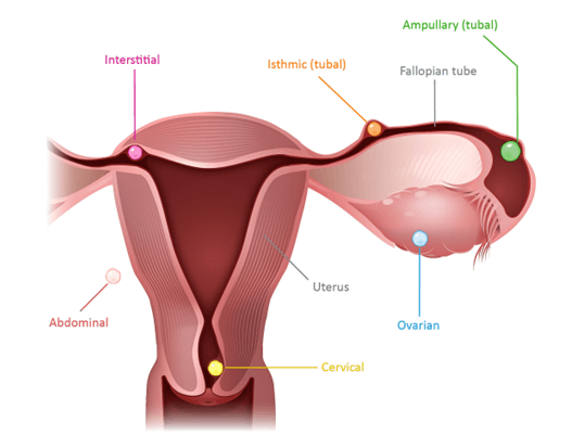 Sites Of Eptopic Pregnancy Ectopic Pregnancy Foundation